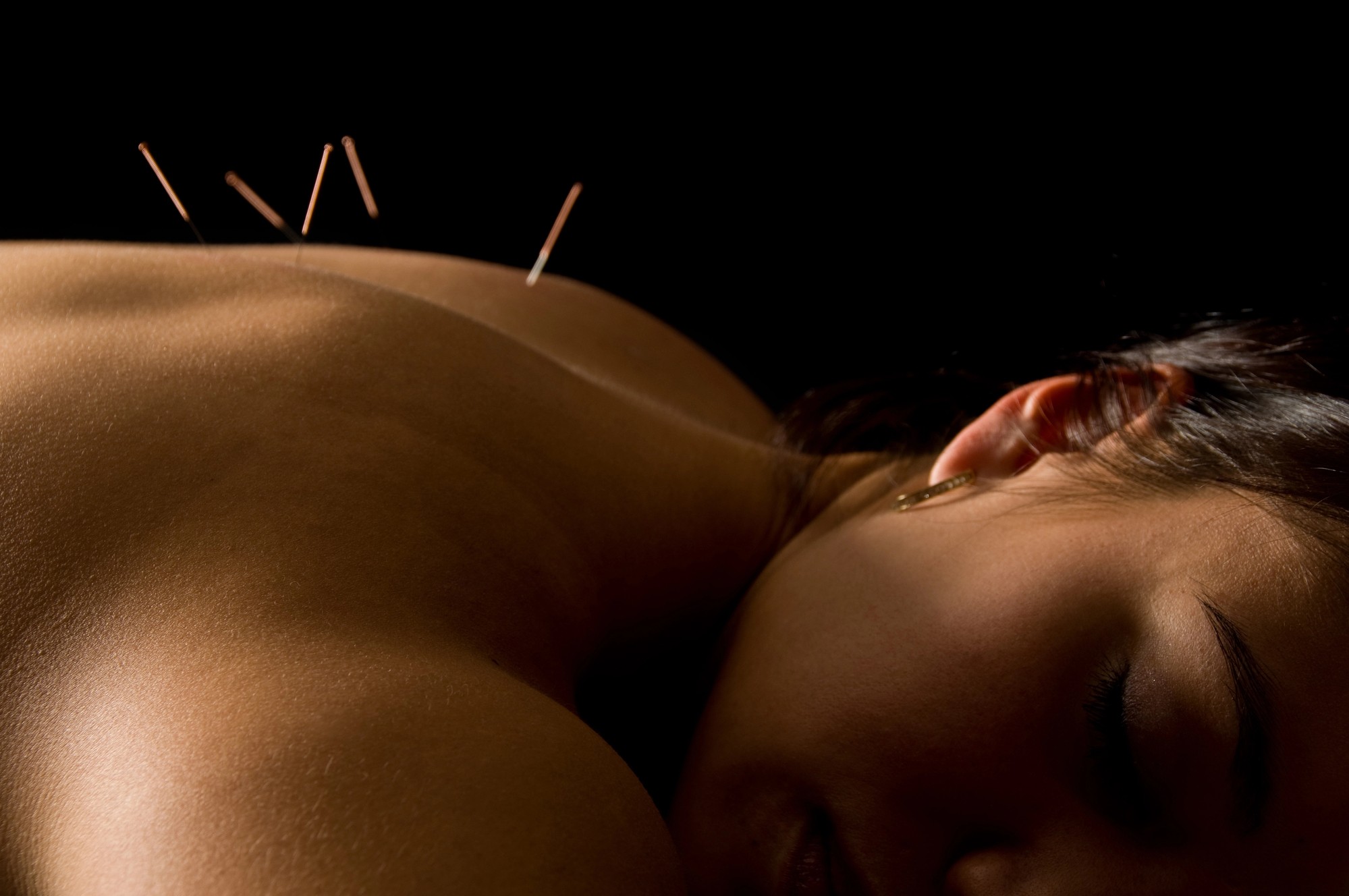 Accupuncture Services